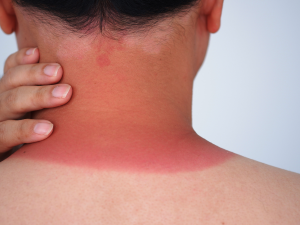 Mélanomes : le danger caché derrière un simple coup de soleil